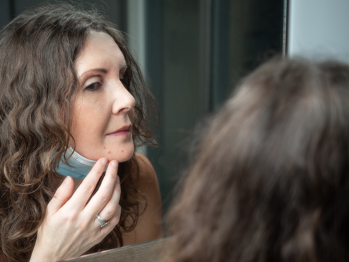 kobieta ogląda się w lustrze, na brodzie ma trądzik spowodowany 