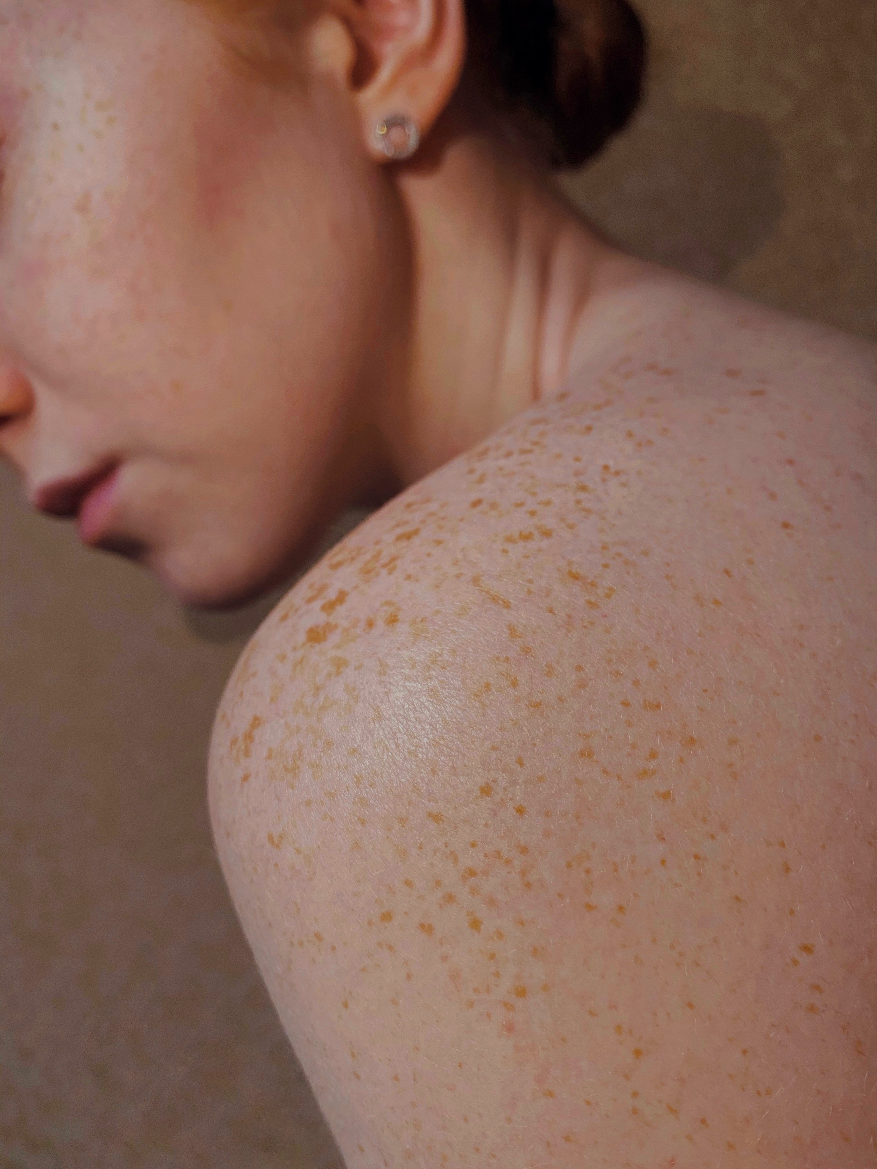 zdjęcie kobiety odwróconej plecami, widzimy jej gołą skórę na ramieniu pełną piegów